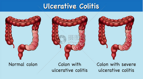 显示溃疡结肠炎插图的表图片