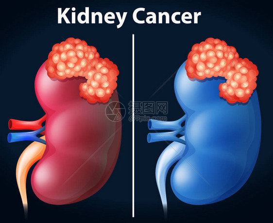肾癌图解两图图片