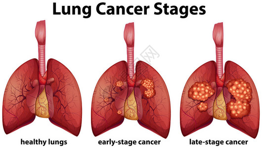 显示肺癌阶段图的表图片