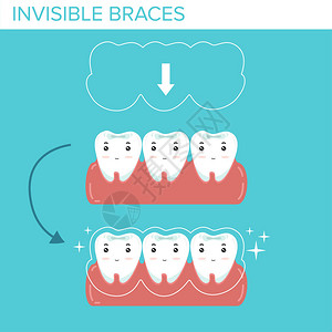 蓝色背景上有隐形牙套的牙齿图片