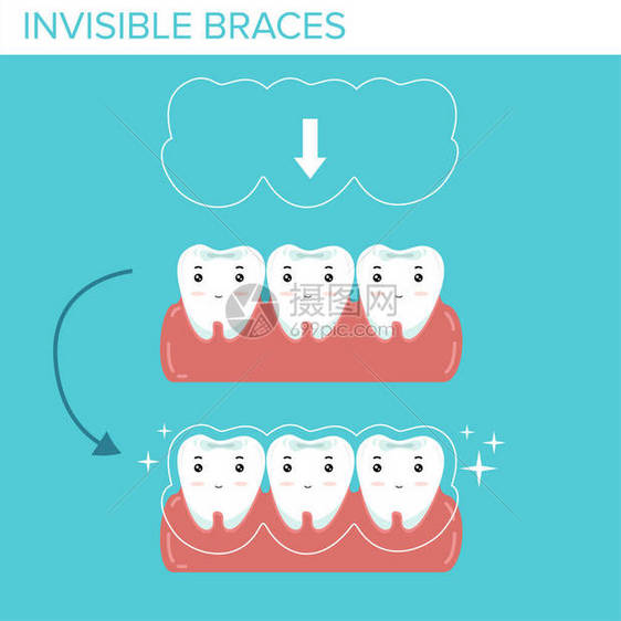 蓝色背景上有隐形牙套的牙齿图片