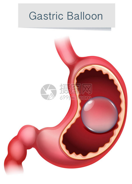 人体解剖胃气球插图图片