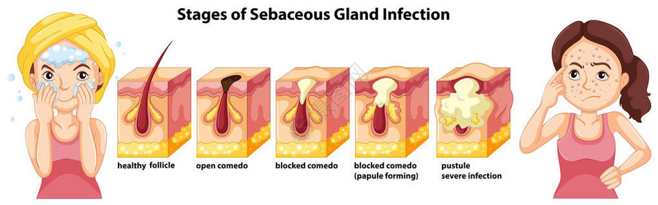 Sebaceous土地感染情图片