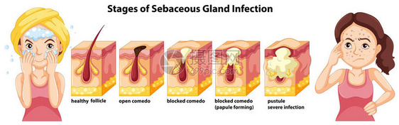 Sebaceous土地感染情图片