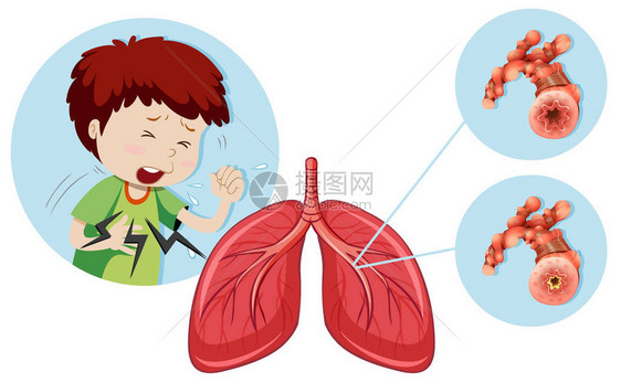 一个患有慢阻塞肺病的人插图图片