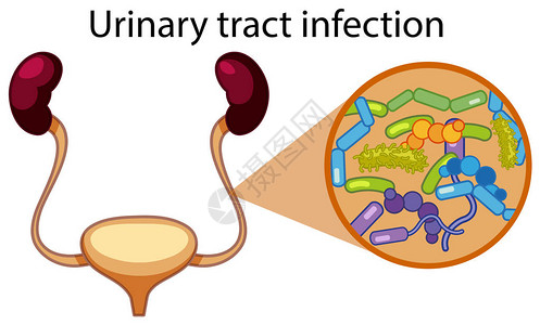 人类尿路感染图图片