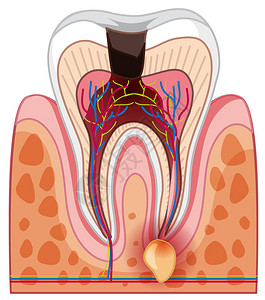 人类蛀牙和蛀牙插图图片