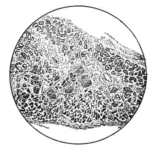 表明纤维组织慢间歇胰腺炎雕刻的老古代图图片