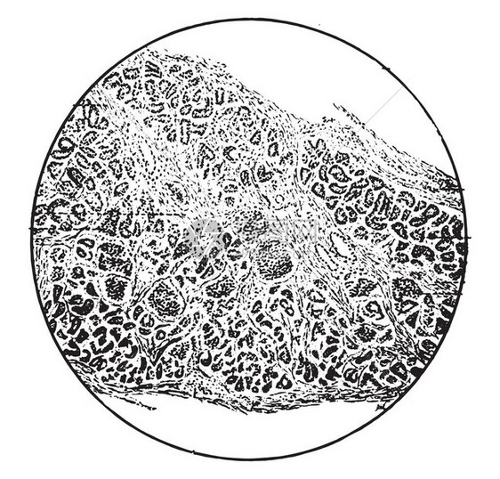 表明纤维组织慢间歇胰腺炎雕刻的老古代图图片