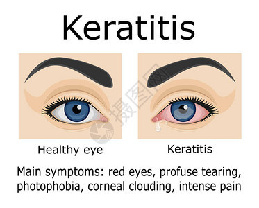 眼科疾病角膜炎的症状说明图片