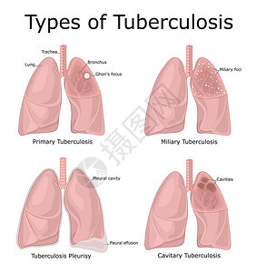 不同类型结核病初级军事蓄图片