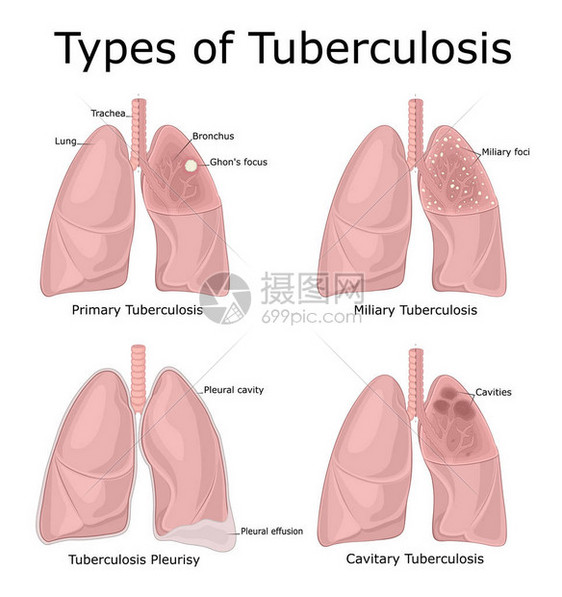 不同类型结核病初级军事蓄图片