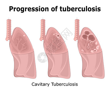 胃肺结核病增速插图CavitalPulturalMultary图片