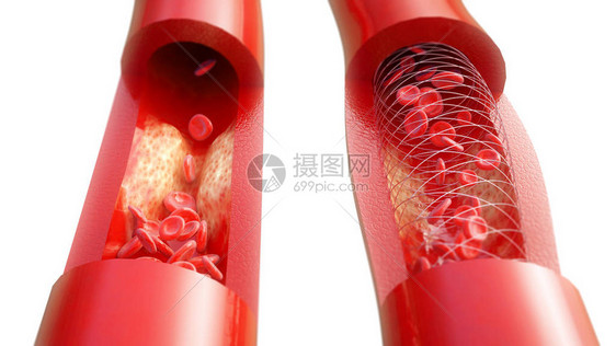 甲状腺硬化及其在白色图片