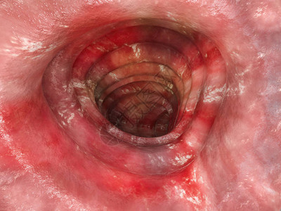 溃疡结肠炎第3阶段图片