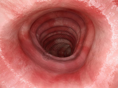 溃疡结肠炎第1阶段图片