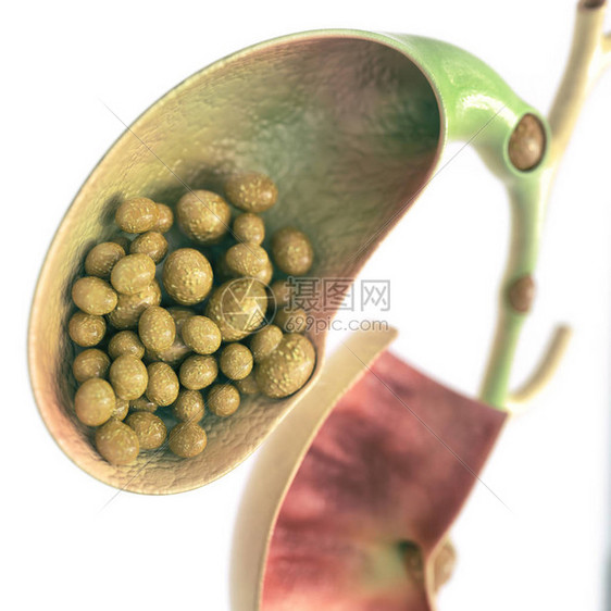 胆囊和胆管中的胆结石高细节图片
