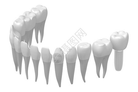 种植牙种植牙背景图片