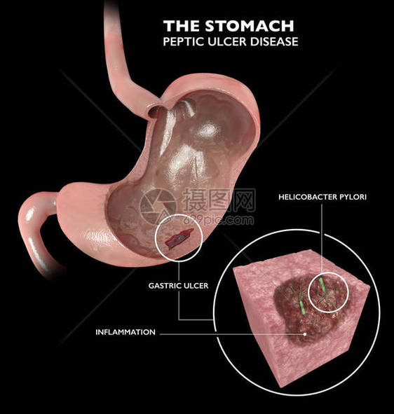 胃的第3d部分消化溃疡疾病图片