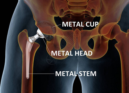 从医学角度准确说明更换臀部的情况图片