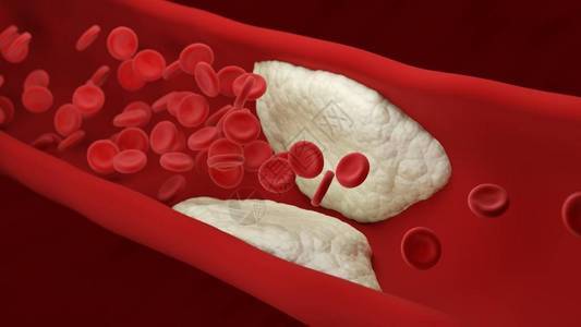 动脉粥样硬化斑块在动脉内积聚血细胞3d插图图片