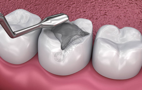 牙科裂缝填充医学精图片