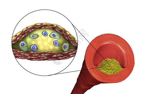 动脉粥样硬化斑块的结构插图显示坏死中心泡沫细胞胆固醇斑块内的T淋巴细胞图片