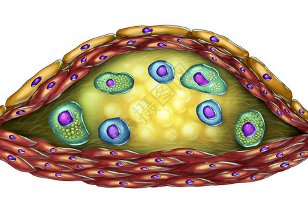 动脉粥样硬化斑块的结构插图显示坏死中心泡沫细胞胆固醇斑块内的T淋巴细胞图片