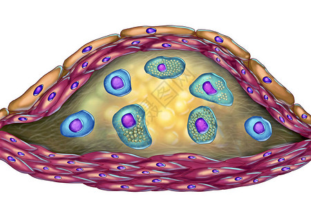 动脉粥样硬化斑块的结构插图显示坏死中心泡沫细胞胆固醇斑块内的T淋巴细胞图片