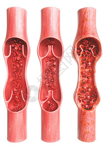 与健康的血管相比静脉变异图片