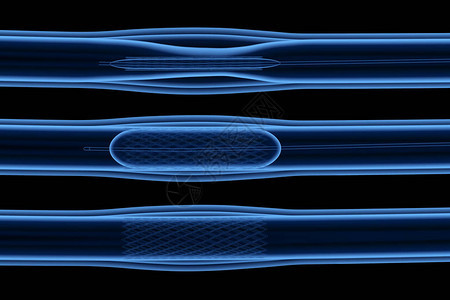 3d静脉刺塞的X射线气球图片