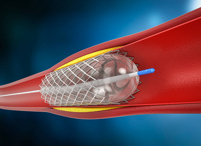 3d渲染球囊血管成形术与静脉支架图片