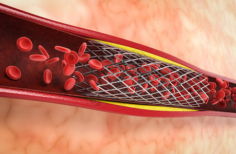 3d渲染球囊血管成形术与静脉支架图片