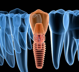 以植入X光透视方式进行牙前齿恢复图片