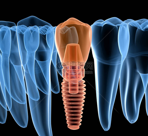 以植入X光透视方式进行牙前齿恢复图片