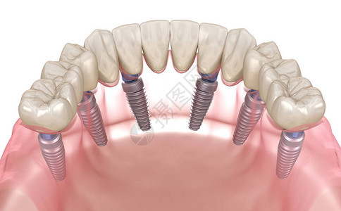 下颌假体Allon6系统由植入物支持人类牙齿和假牙概念的医学上准确的图片