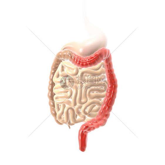 显示溃疡结肠炎UC结肠和直肌炎症和溃疡的3D插图图片