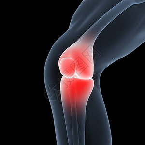人体骨联合疼痛膝合症3图片