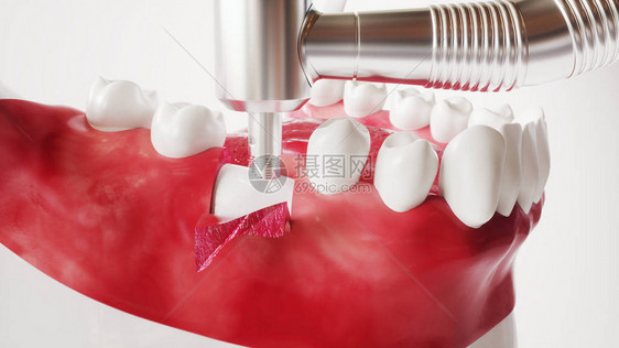 牙齿植入图片系列图片