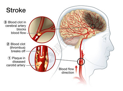 显示颈动脉血凝块断裂和阻断血液流中图片