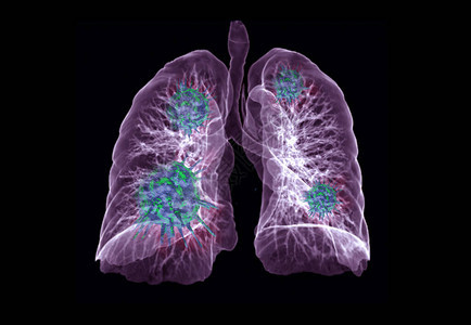 CT胸部或肺3D渲染图像与黑色上的渲染背景图片