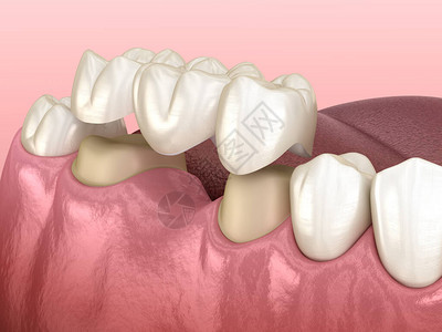 用于人体牙齿治疗的医学精确3D插图背景图片