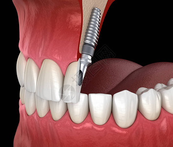用植入器进行中央切口恢复医学上准确的牙科图片