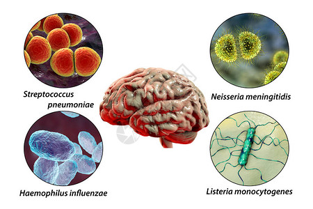 细菌脑膜炎的病因图片