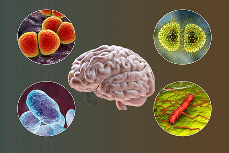 细菌脑膜炎的病因图片