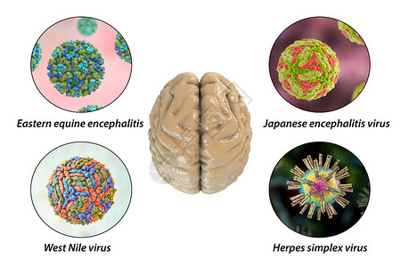 脑感染微生物引起脑炎和图片