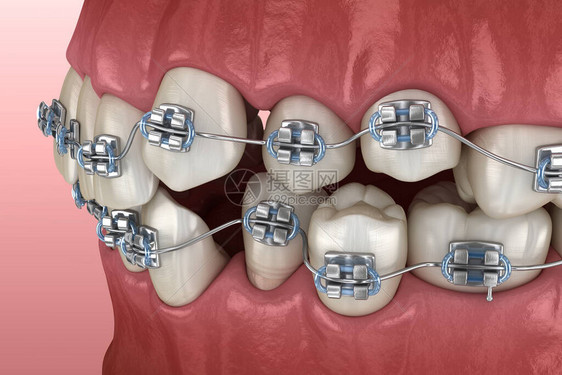 异常牙齿姿势和金属牙套对立医学上准确的图片