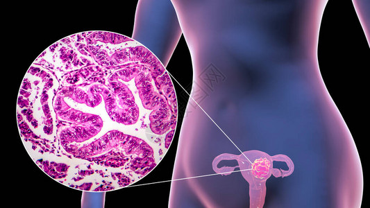 子宫癌3D图例和光显微镜显示女图片
