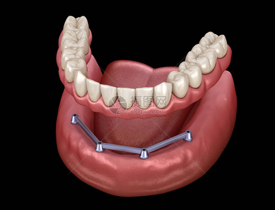 全靠4个系统由植入器支持医学上准确的人体牙齿和假牙3D插图图片