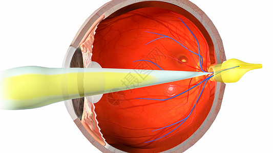 日光性视网膜病变高清图片